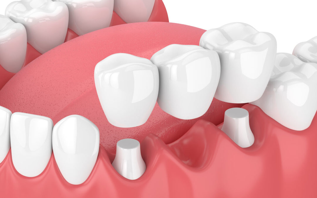How to Fix a Cracked Dental Bridge?