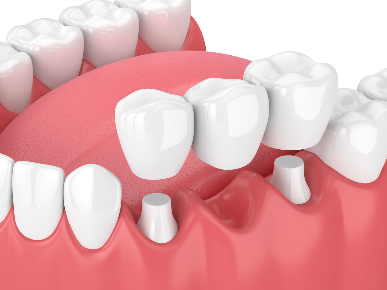How to Fix a Cracked Dental Bridge? Sue Vetter, DDS Seattle