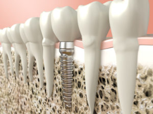 Dental implants