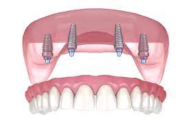 All-on-4 Dental Implants: A Comprehensive Solution for Missing Teeth