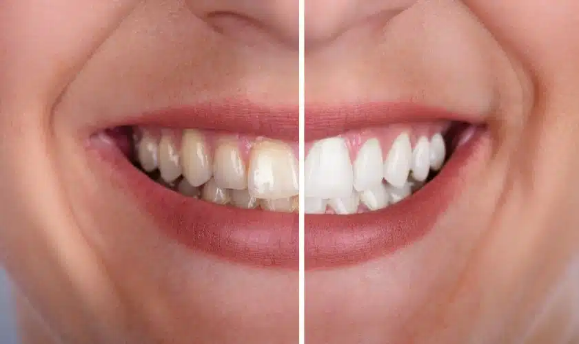 Brightening Your Smile: The Impact of Teeth Whitening