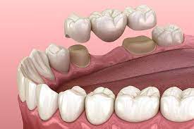Dental Bridges: Treating Dental Issues and Restoring Smiles