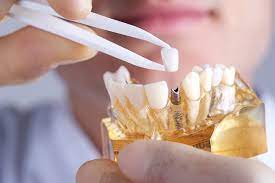 Dental Implants: The Ideal Solution for Missing Teeth