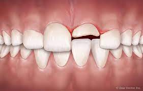  Dental Trauma Treatment: Restoring Oral Health After Injury