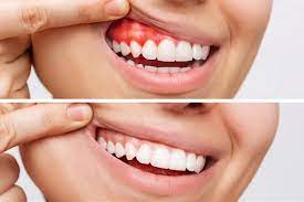Effective Treatments for Gum Disorders