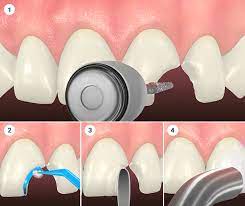 Exploring Different Types of Tooth Bonding