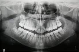 Exploring the Various Types of Dental X-Rays