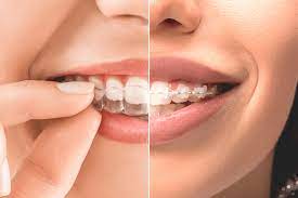 Invisalign vs. Braces: Choosing the Right Orthodontic Treatment