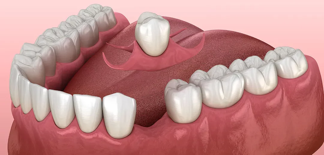 Removable Flippers: A Viable Option for Missing Teeth