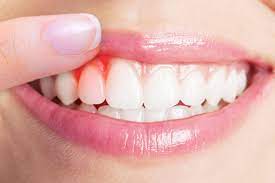  Understanding Gum Disorders: Causes, Symptoms, and Treatment